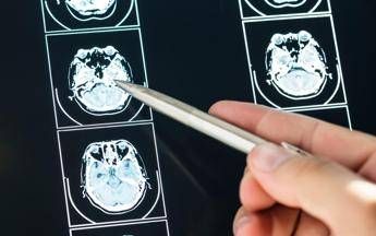 Intelligenza Artificiale può prevedere evoluzione Parkinson, lo studio italiano