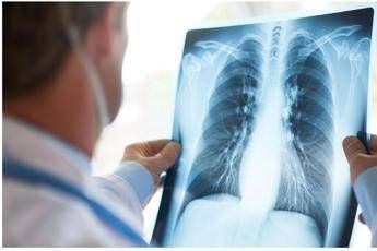 Curare il cancro al polmone senza chirurgia, prima italiana all’Ieo di Milano