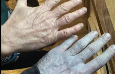 Va a letto sano, ma si risveglia di colore blu: l’incredibile storia di un 42enne