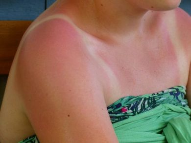Melanoma, studio Iqvia: meno di un italiano su 4 controlla i nei