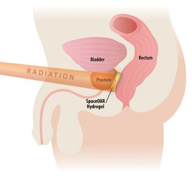 Al San Carlo di Potenza innovazione nella radioterapia carcinoma prostata
